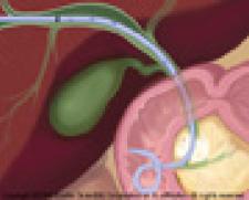 AccuStick II Introducer System from Boston Scientific for placement of 038